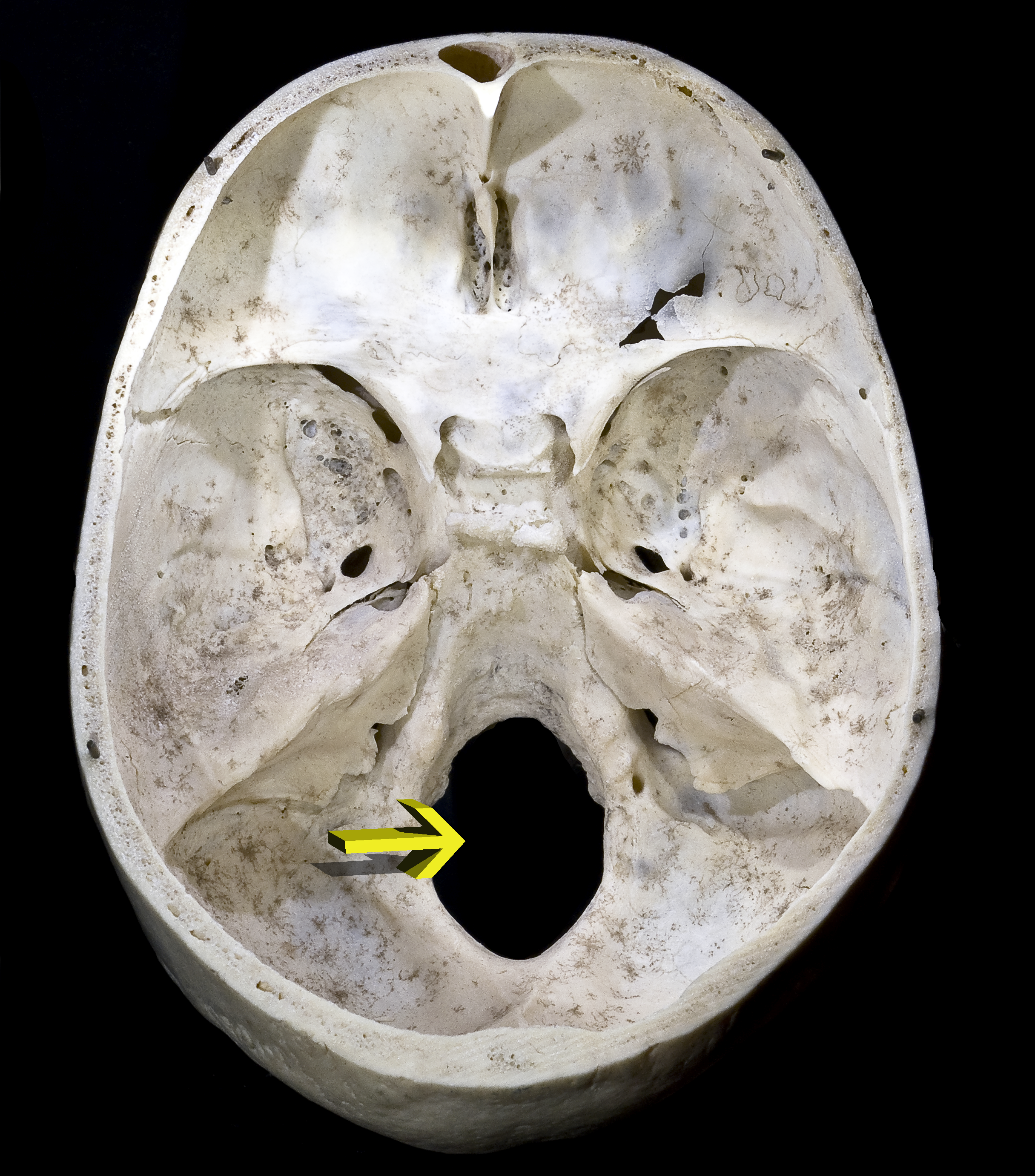 Read more about the article Unraveling the Foramen Magnum: A Comprehensive Guide for Medical Students