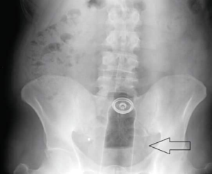 Read more about the article Proctalgia: A Unique Case of Rectal Foreign Body