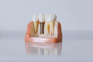 Read more about the article Dental Implants: All You Need To Know