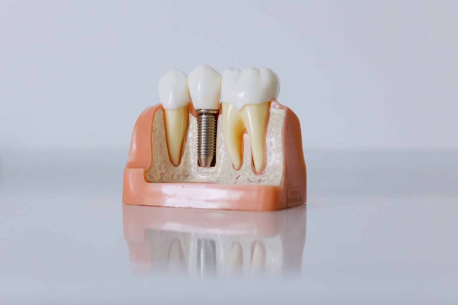 close up shot of dental implant model